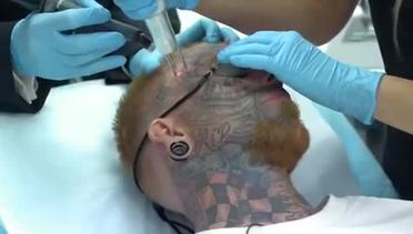 Begini Caranya Menghapus Tattoo Dengan Teknologi Laser