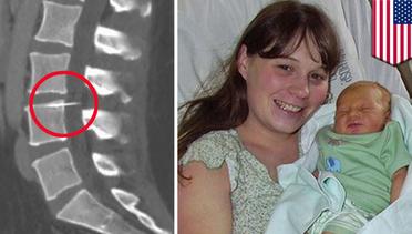 Seorang ibu baru menyadari ada jarum tertinggal di tulangnya setelah 14 tahun - TomoNews