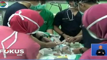 Dempet Perut, Operasi Pemisahan Bayi Kembar Siam Sukses - Fokus Sore