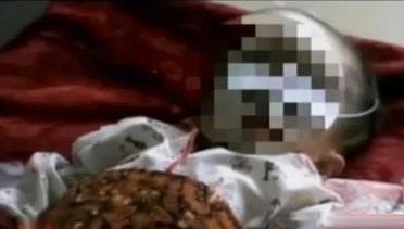 Bayi Diduga Korban Kabut Asap Jambi Derita Pembengkakan Kepala