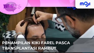 Kiki Farel Pamerkan Penampilan Rambut Barunya Pasca Transplantasi Rambut Di Turki | Moji