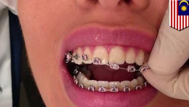Bibir wanita terkena infeksi gara-gara kawat gigi palsu - TomoNews