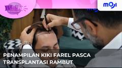 Kiki Farel Pamerkan Penampilan Rambut Barunya Pasca Transplantasi Rambut Di Turki | Moji
