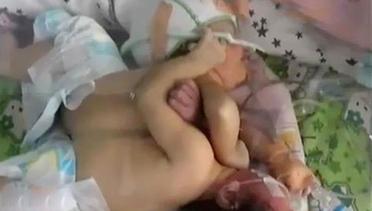 VIDEO: Bayi Kembar Siam di Tasik Butuh Biaya Operasi Pemisahan