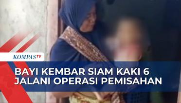 16 Dokter Spesialis Terlibat dalam Operasi Pemisahan Bayi Kembar Siam di Lombok