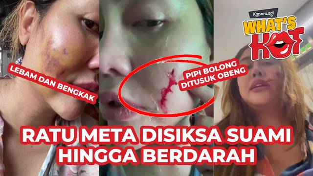 Ratu Meta Unggah Bukti Alami KDRT Dari Sang Suami, Pipi Sampai Bolong Dan Berdarah