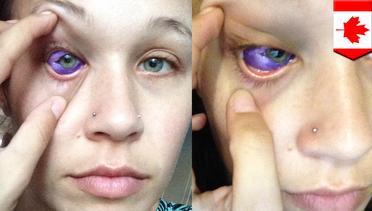Tato mata gagal: Model tato mata berakhir kehilangan penglihatannya - TomoNews