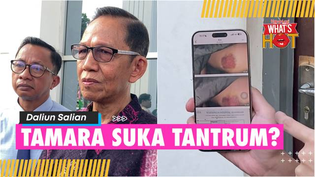 Sahabat Tamara Tyasmara Beberkan Bukti Lebam Dugaan Kekerasan, Pihak Yudha Arfandi Beri Pembelaan