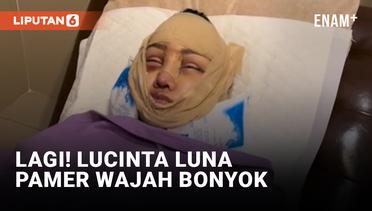 Lucinta Luna Pamerkan Wajah Bonyok Pasca Operasi Rahang dan Tulang Ekor