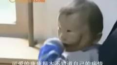 bayi di china mempunyai kelainan hingga terlihat mempunyai 2 wajah