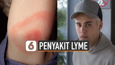 Kenali Lyme, Penyakit yang Diderita Justin Bieber