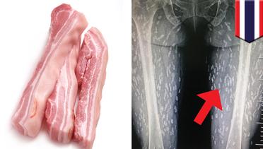 Kaki wanita terinfeksi cacing parasit karena makan daging babi mentah - TomoNews