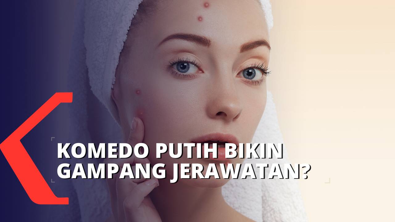 Ketahui, Ini Perbedaan Komedo Putih dan Hitam | Vidio