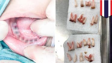 Bocah 4 tahun kehilangan 18 gigi karena jarang sikat gigi - TomoNews
