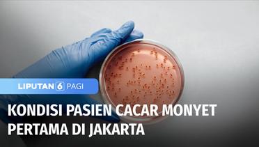 Kasus Pertama Cacar Monyet atau Monkeypox Pertama di Jakarta, Pasien Jalani Isolasi | Liputan 6