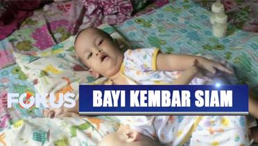 Operasi Pemisahan Bayi Kembar Siam Tangerang Terkendala Biaya - Fokus  