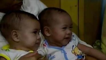 VIDEO: RSCM Berhasil Lakukan Pemisahan Bayi Kembar Siam