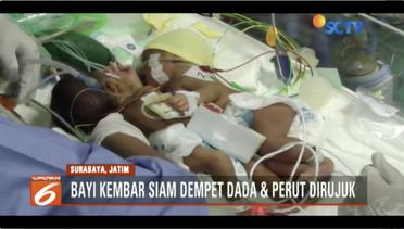  Dokter di Surabaya Tangani Bayi Kembar Siam Dempet – Liputan6 Petang Terkini