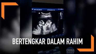 Bayi Kembar Bertengakr dalam Rahim Saat di USG