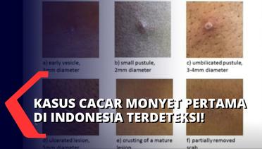 Waspada! Kasus Cacar Monyet Sudah Terdeteksi di Indonesia: Pasien Pertama Warga Jakarta