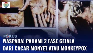 Kasus Cacar Monyet Sudah Ada di Indonesia! Begini Cara untuk Pencegahannya! | Fokus
