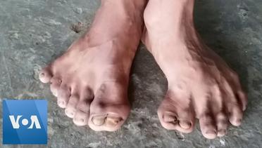 Indian Family of 25 Have Extra Fingers and Toes