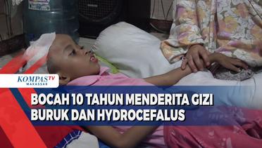 Bocah 10 Tahun Menderita Gizi Buruk Dan Hydrocefalus