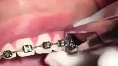Beginilah proses pelepasan behel pada gigi