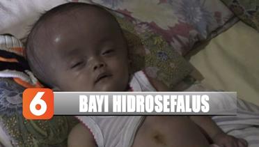 Bayi 10 Bulan di Nganjuk Derita Hidrosefalus - Liputan 6 Pagi