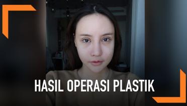 Transformasi Wajah Usai Operasi Plastik, Hasilnya Menakjubkan