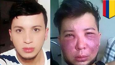 Operasi plastik gagal wajah pria Kolombia hancur hingga bernanah - TomoNews